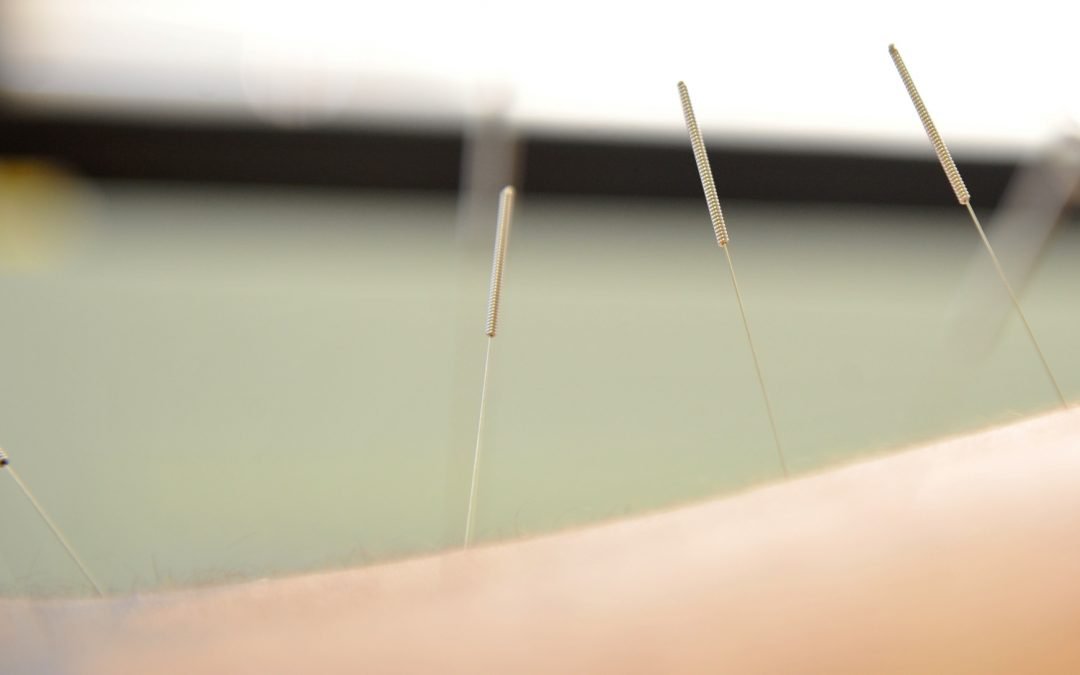 Acupuncture, IMS & You